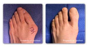 before and after image patient 42